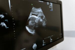 primeiro trimestre de gravidez ultrassom